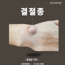 결절종 한의원 코모코한의원 후기와 원인