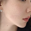 (주)압구정하루 | 압구정피부과 추천, 엠보·통증 적은 비타란 내돈내산 후기