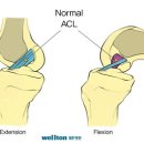 [무릎 통증] 십자인대 파열 증상과 그 치료법에 대하여 알아보자. 이미지