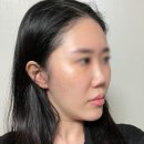 청담동피부과 기미치료피부과 닥터이레이저 1,2회차 후기