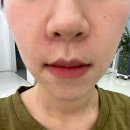 수원시원한의원 | 수원인계동 피부과 세모아의원 팔자필러 내돈내산 대만족 후기