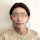 차이성형외과의원 | 역삼동성형외과 실리프팅 가격 왜 차이 날까 실 종류와 고정 방식