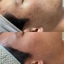 올레오사 | 대전 여드름압출 잘하는곳 찾기 전에 이것부터 확인하세요
