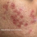 더레드피부과의원 | 더레드 피부과 여드름흉터 패인흉터 레이저 치료 내돈내산 리얼후기 - 2회차