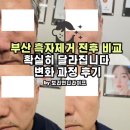 씨유 양정현대프라자 | 부산 흑자제거 전후 비교 확실히 달라집니다 변화 과정 후기