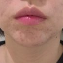 당신의피부과의원 | 명동피부과 뷰티온의원 여드름 치료 후기