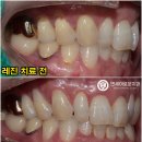 앞니 사이, 씌우지 않고 치료할 수 있을까요?&#34; 당산동 치과 치경부 마모증 및 치간이개 레진 치료 후기