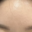 명동리아한의원 | 동대문피부과 여드름흉터 새살침 솔직후기