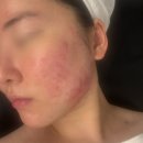 브이메디 | 부천피부관리 브이메디스파 5주차 내돈내산 솔직후기 피부 변화 기록