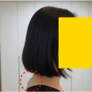 심각한 버섯목, 교정으로 6개월 만에 해결한 후기 (버섯목증후군)