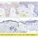 콩팥병 환자 괴롭혔던 '가려움증'.. 원인물질 발견돼 이미지