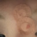 장미꽃과 나이팅게일 피부과의원 | 수원 영통 | 장미꽃과 나이팅게일 외과 얼굴 피지낭종 제거 수술 후기