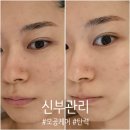 중원-131 | 트러블 + 모공부자 예비신부의 성남피부관리 후기