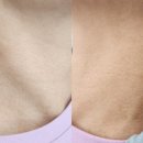 수아뷰티X베르떼두피&탈모 | [평택,송탄]실면도로 쥐젖제거 받고 왔어요.