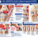 무릎 MCL 손상 테이핑 내측측부인대 해부학과 무릎 안정성 이해하기. 이미지