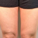콜 디자인 | 강남역피부과 데옥시콜산 허벅지 시술 후기 무릎 위 군살 제거 탄력 라인 2주 변화