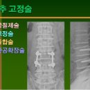 허리디스크병 - 치료 (4) / 직접적인 수술법 이미지