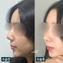 코도 | [무보형물 코수술 후기]심한 매부리코도 자연스럽게 자가재료만으로