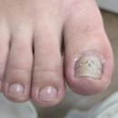 레푸스 감삼점&에이레네 | 대구내성발톱 고민 끝에 찾은 레푸스감삼점&amp;에이레네 솔직 후기