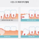 이석기의미치과의원 | 청주송정동치과 매복 사랑니? 아프지 않아도 검진이 필요한 이유 3가지