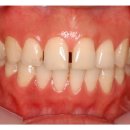 치아성형비용 벌어진 치아의 라미네이트 치아성형. 웃을때 치아가 벌어졌을때 이미지