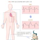 급성심근경색증진단비보장 특별약관과 급성심근경색증진단비Ⅱ보장 특별약관의 비교 이미지