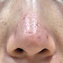 강림한의원 | 내돈내산 홍대 ㄹㄷ 한의원 새살침 후기/수술흉터제거/4회차