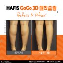 종아리퇴축술후기 쭉 뻗은 각선미를 완성해요!