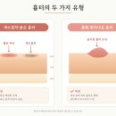 우정의료기기 | 흉터 | 초기·중기·후기 단계별 가이드