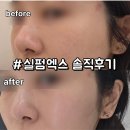 씨유진해이동대로점 | 선정릉역피부과 실펌x 레이저 후기, 모공 기미 효과 포텐자 통증 비교