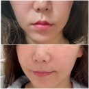 미희뷰티 | 홍대피부과 팔자주름 관리 부작용 없는 미희주사 후기