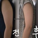 강남역피부과 바디 온다레이저 리쥬엘 팔 리프팅 후기