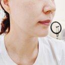 포항시북구84 | 처진 불독살 더결뷰티에서 하이푸리프팅받은 후기 포항북구피부관리