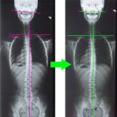 서초리더스정형외과재활의학과의원 | 머리기울어짐 교정전후 비교 및 간단후기 - 교대역 2호선 정형외과 도수치료 강남수재활의학과의원