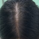 릴리의 생활공장 | [내돈내산 강남역 헤어온의원] 30대 여성 정수리 탈모 치료 10회차 후기! 🌱 (4달 경과)