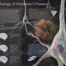 노화공공도서관 | 알츠하이머: 유형, 진단·치료 최신 동향 및 미래 전망