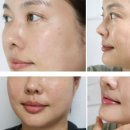 수한의원 | 내돈내산 망포동 한의원 기미 태반주사 온다리프팅 후기