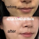 [공지] 서면피부과 유스힐 1주일 솔직후기