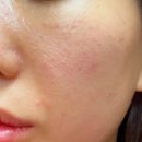 신논현/강남피부과 버츄RF 시술 가격 통증 효과 리얼 후기