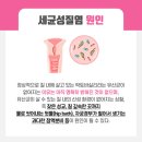 자연치유약국 | 칸디다질염 곰팡이질염 유산균 효과 1도 없어요 질염 자연치유 후기
