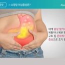 4기에 발견되기 쉬운 소장암 증상 원인 생존율 이미지