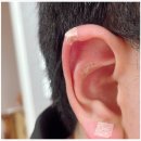 귀로 보는 건강클리닉 이혈 | 이침 이혈테라피가 뭐야? 셀비오 이어밸런스 귀 지압 패치