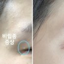 잘짓는약국 | 약국 비립종 연고 골라야하면 구분짓는 법 공유해요 (사진있음)