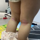 덕하한의원 | 아기 팔다리 습진에는 프라젠트라 더마아토크림으로