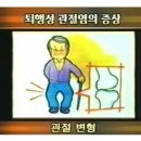 인공관절수술-1(무릎통증,퇴행성관절염,무릎인공관절,관절내시경,무릎연골수술) 이미지