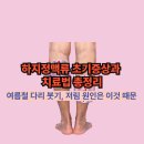 하지정맥류 초기증상과 치료법 총정리｜여름철 다리 붓기, 저림 원인은 이것 때문