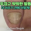 세곡 | [레푸스 강남세곡점] 4월 관리후기 모음 - 발각질 / 무좀발톱 / 발톱통증