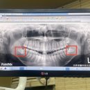 바른정플란트치과의원 | 부산 매복사랑니 발치 대학병원 가라고요..? 그래서 결국 발치가능한 곳 찾았다