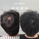 어던 | 하남 두피문신 추천 남편 탈모 컴플렉스 탈출 후기 어던헤어