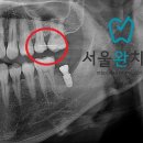 송파나루역 서울완치과, 정확하고 안전하게 오스템 네이게이션 임플란트